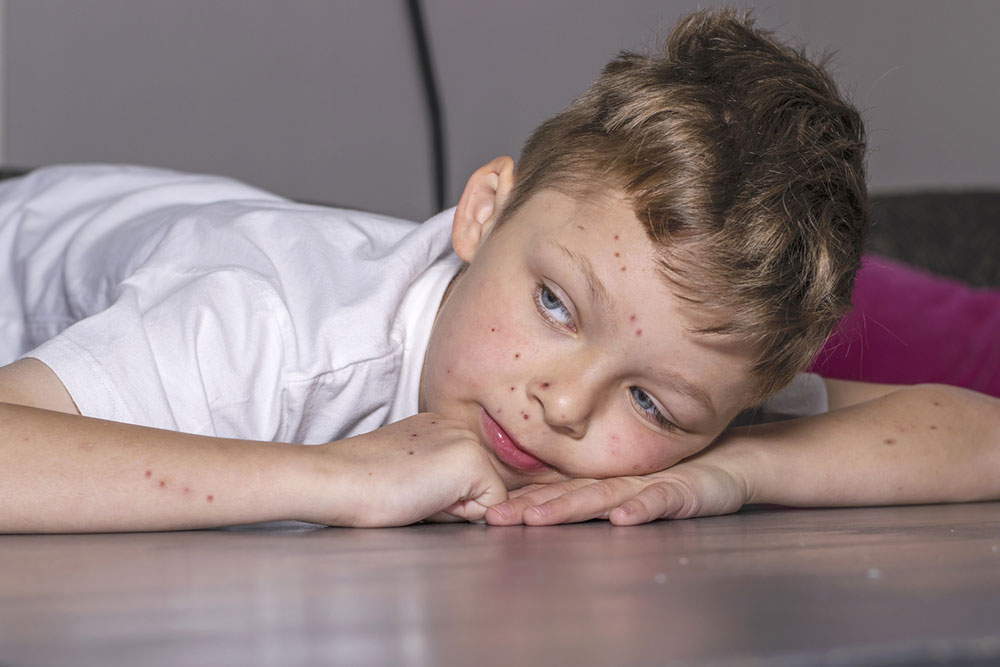 A brief overview of chickenpox