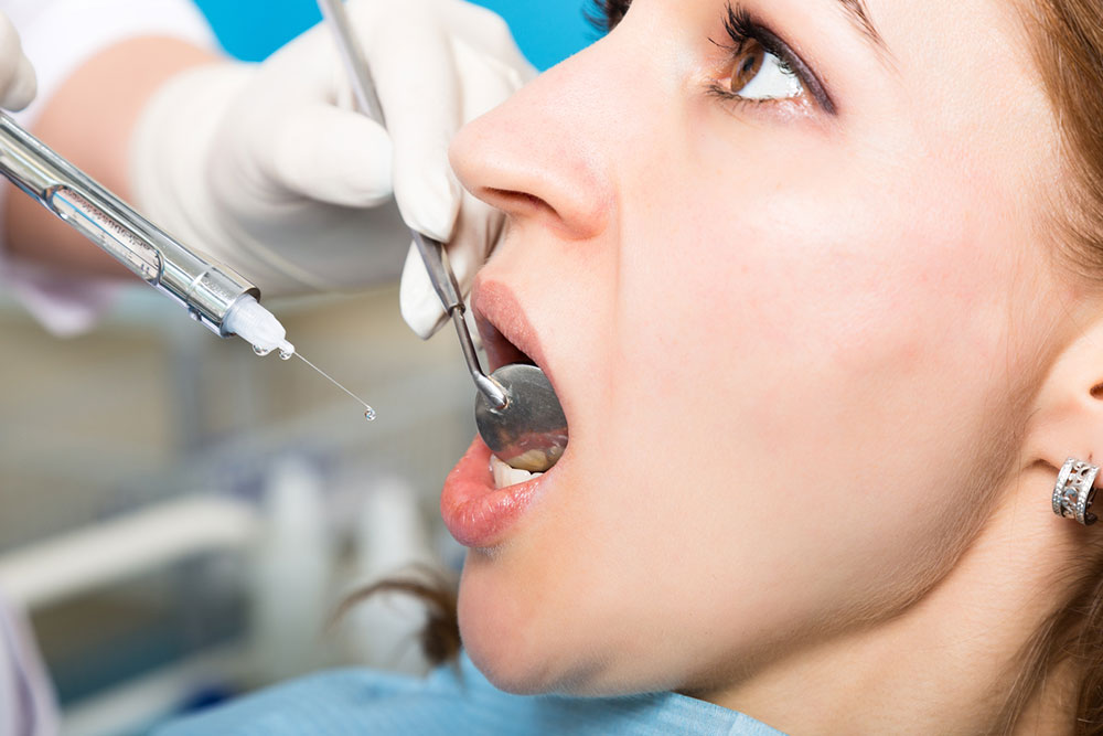 An overview of tooth cavities