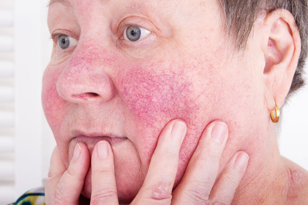 An overview of rosacea