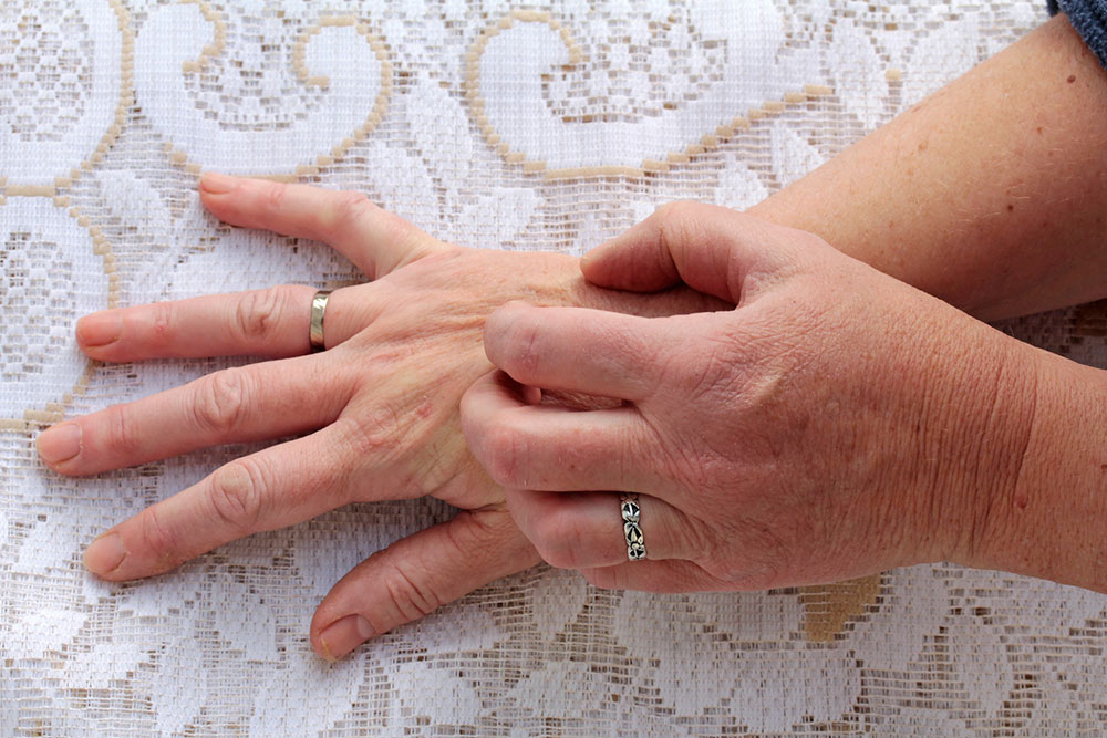 Atopic Dermatitis: Causes and Symptoms