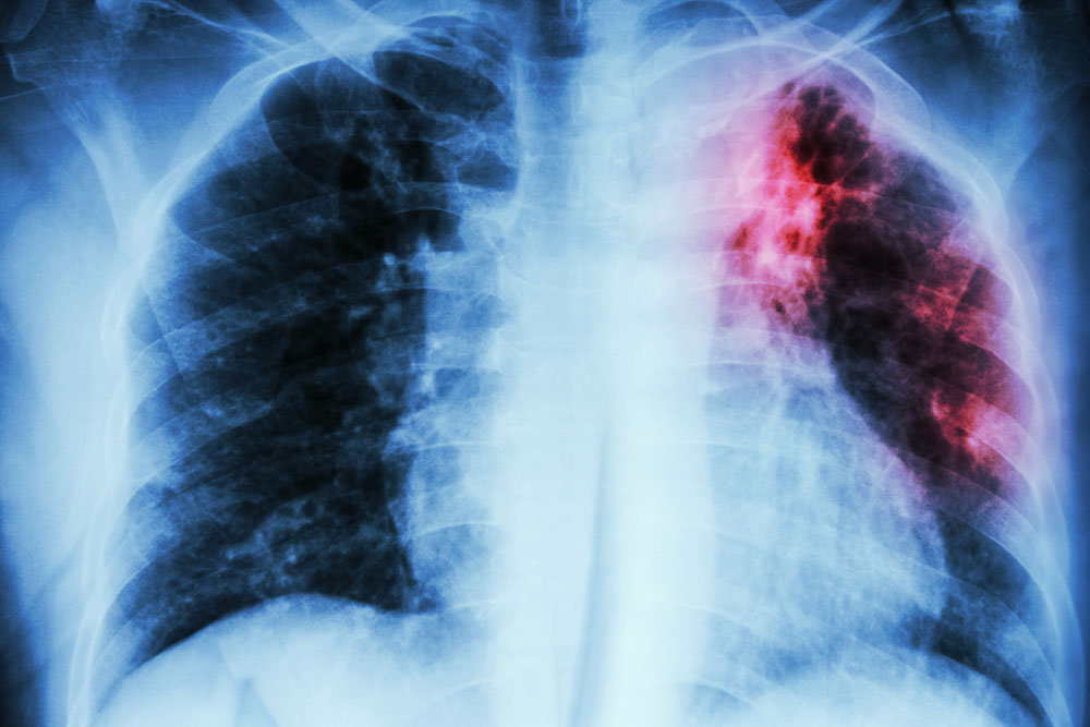 Everything you need to know about tuberculosis