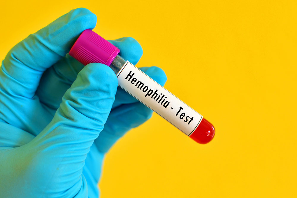 Hemophilia – Signs, symptoms, and diagnosis