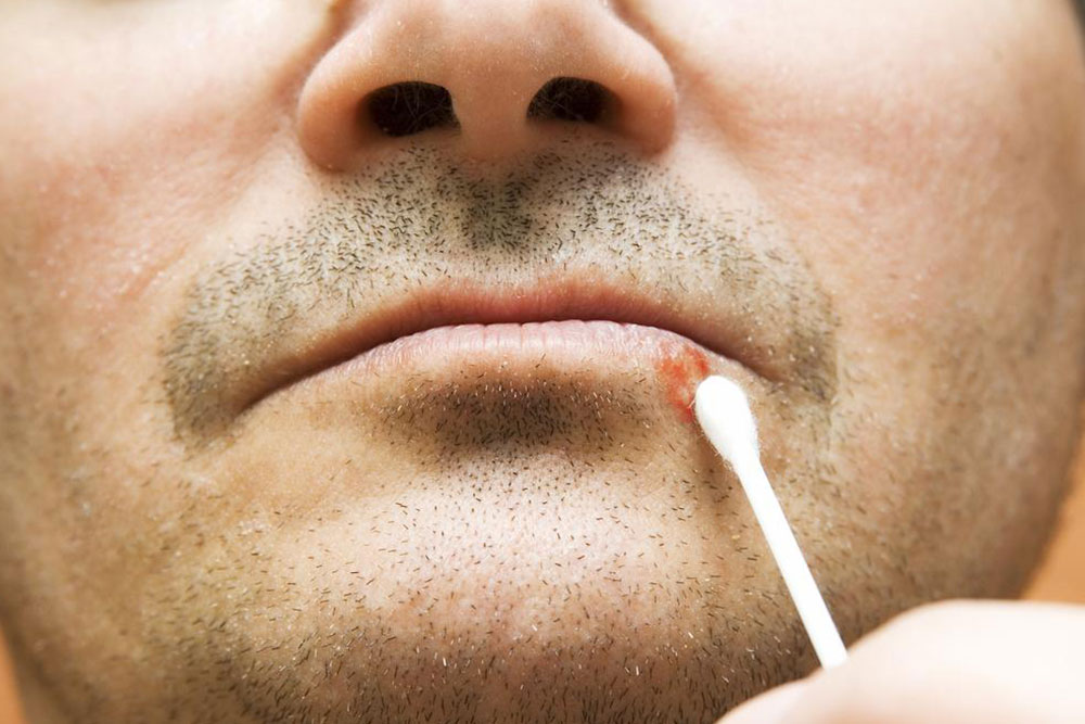 Top ways to get rid of canker sores
